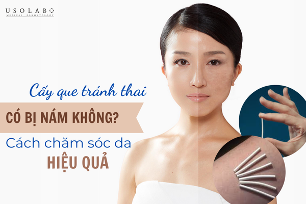 Cấy que tránh thai có bị nám da không