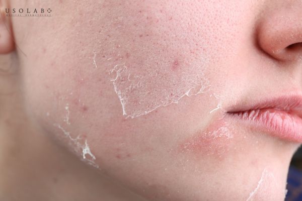 Da khô có dùng được retinol không? Những bí quyết sử dụng an toàn - ảnh 1