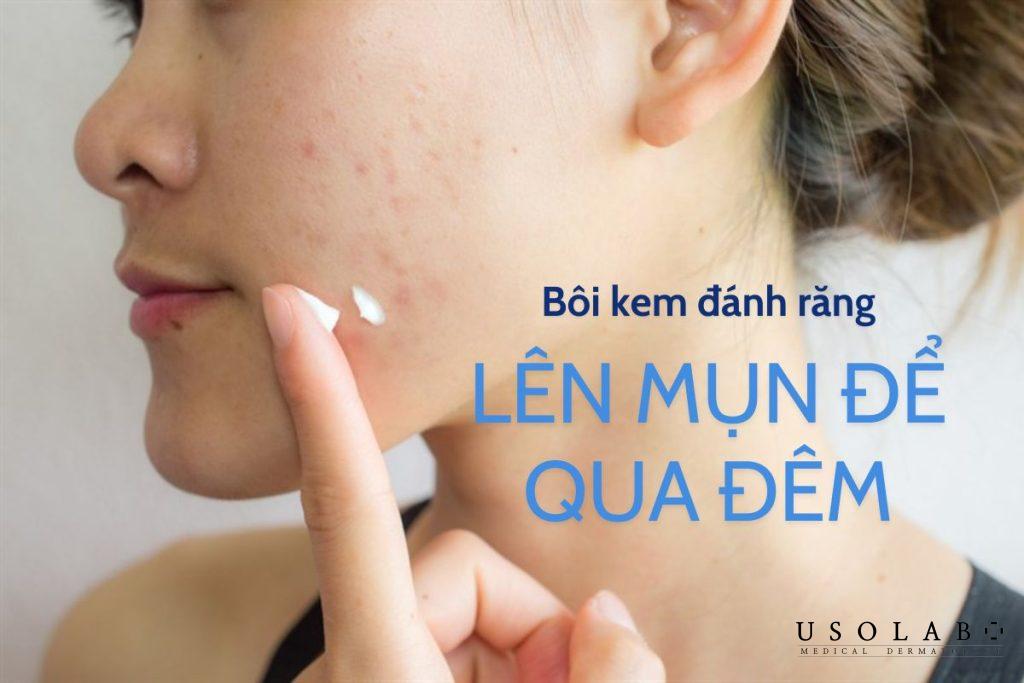 Bôi kem đánh răng lên mụn để qua đêm hiệu quả hay nguy cơ tiềm ẩn