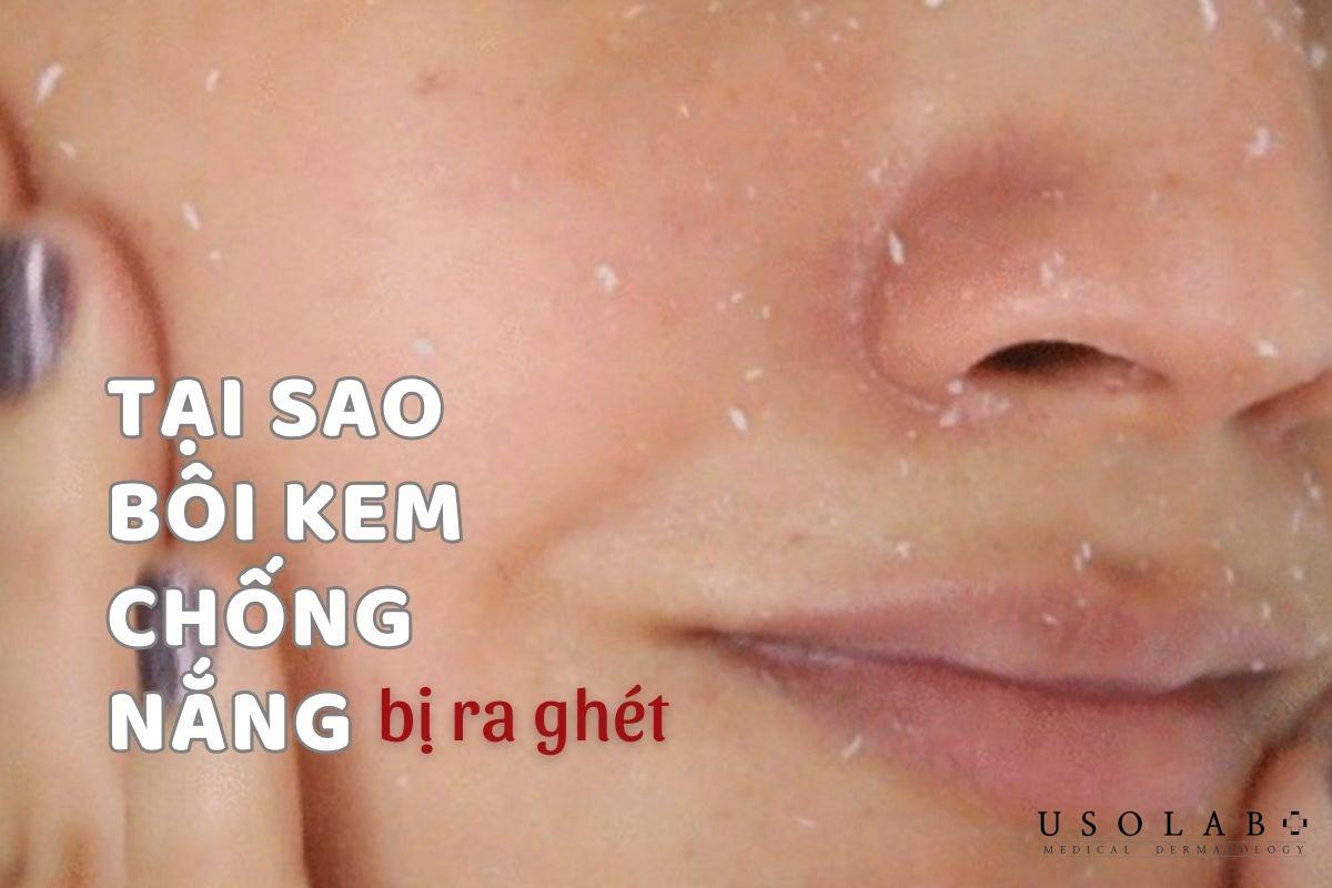 Tại sao bôi kem chống nắng bị ra ghét? Cách khắc phục thế nào - ảnh 1