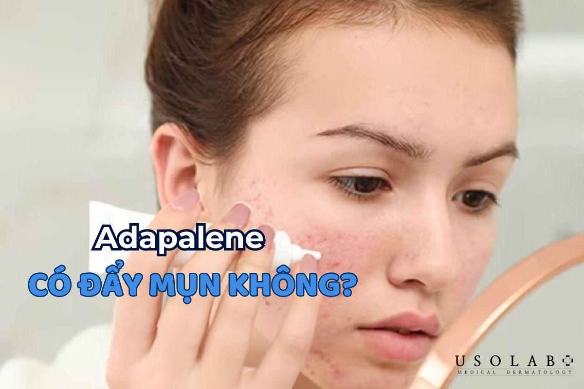 Adapalene có đẩy mụn không? Cách sử dụng hiệu quả cho da mụn - ảnh 2