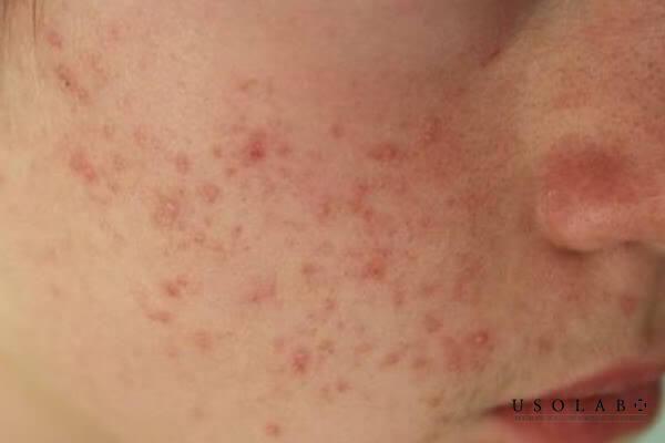 Có thể điều trị thâm đỏ và thâm đen cùng lúc