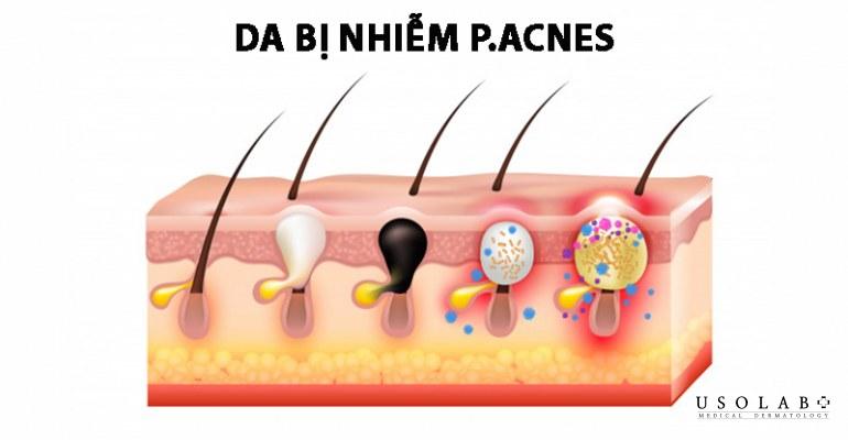 Cồi mụn có tự hết không? Xử lý cồi mụn an toàn, đúng cách - ảnh 2