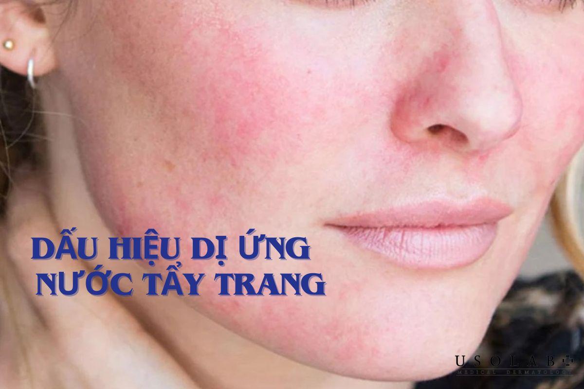 Dấu hiệu dị ứng nước tẩy trang: Nhận biết và xử lý thế nào? - ảnh 2