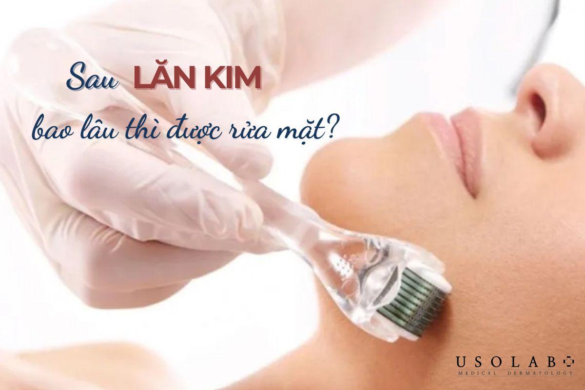 Sau lăn kim bao lâu thì được rửa mặt? Cách thực hiện thế nào - ảnh 2