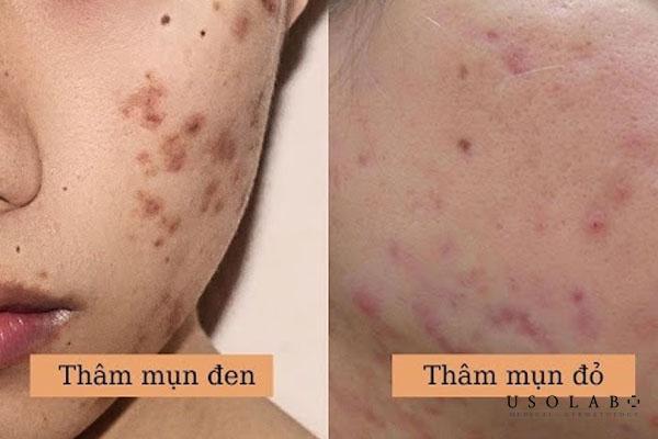 So sánh mức độ nặng nhẹ giữa thâm đỏ và thâm đen
