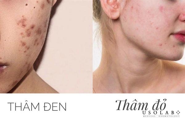 Thâm đỏ và thâm đen là hai giai đoạn của vết thâm sau mụn