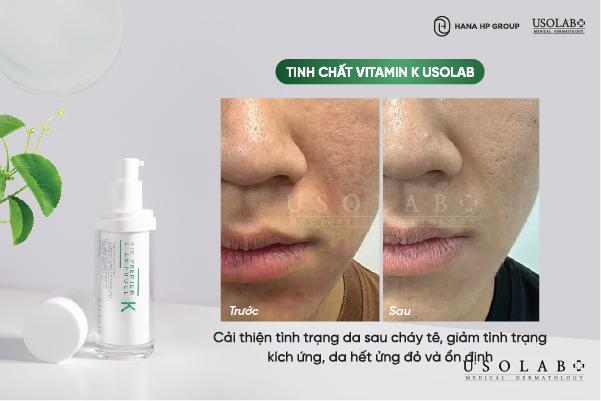 Mọi loại da đều có thể sử dụng tinh chất K Ampoule