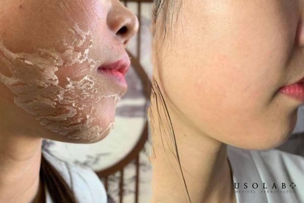 Lựa chọn phương pháp peel phù hợp với làn da