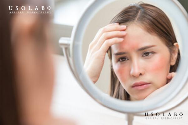 Vitamin k giúp làm giảm đỏ da do giãn mao mạch