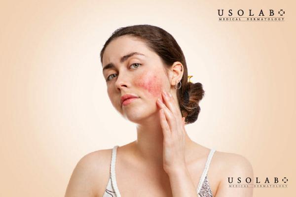 Vitamin K giúp cải thiện tình trạng da Rosacea hiệu quả