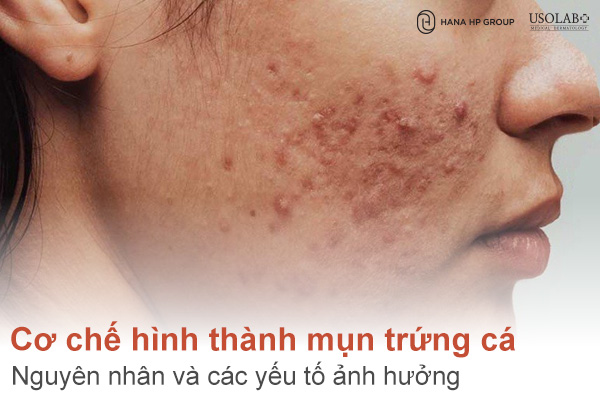 Cơ chế hình thành mụn trứng cá: Nguyên nhân và các yếu tố ảnh hưởng