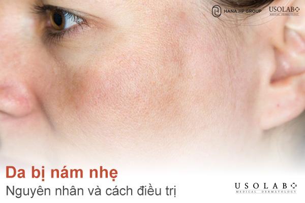 Da bị nám nhẹ có tự hết không? Nguyên nhân và cách điều trị