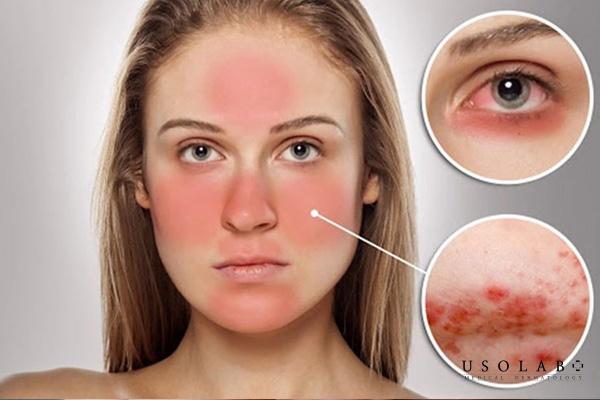 Dị ứng mỹ phẩm là nguyên nhân khiến mặt bị nổi mẩn đỏ và ngứa