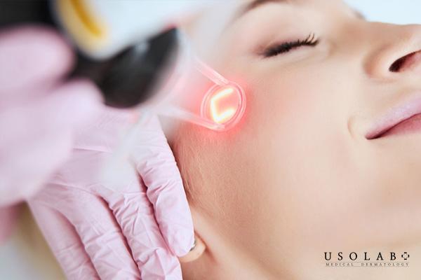 Đốt điện hoặc laser để chữa mụn cơm trên mặt