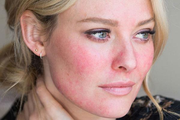 Lưu ý khi sử dụng Vitamin K cho da Rosacea