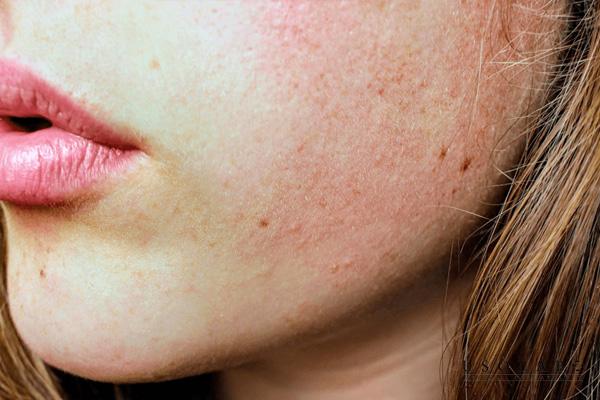 Môi trường và thời tiết là nguyên nhân khiến mặt bị nổi mẩn đỏ và ngứa