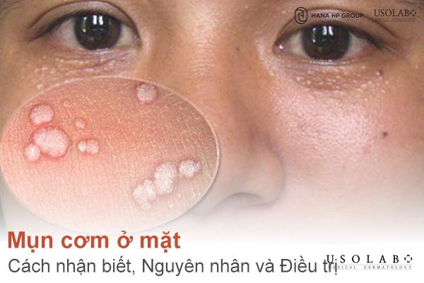 Mụn cơm ở mặt - Cách Nhận biết, Nguyên nhân và Điều trị hiệu quả