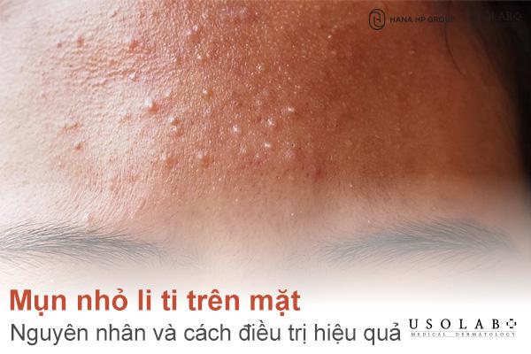 Mụn nhỏ li ti trên mặt là gì? Nguyên nhân và cách điều trị hiệu quả