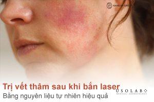 Cách trị vết thâm sau khi bắn laser bằng nguyên liệu tự nhiên hiệu quả