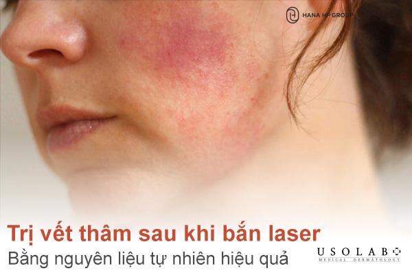 Cách trị vết thâm sau khi bắn laser bằng nguyên liệu tự nhiên hiệu quả