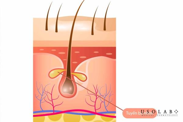 Tuyến bã nhờn hoạt động quá mức gây nên mụn mủ sưng to