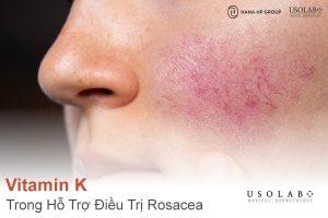 Vitamin K trong Hỗ Trợ Điều Trị Rosacea (Chứng Đỏ Mặt)