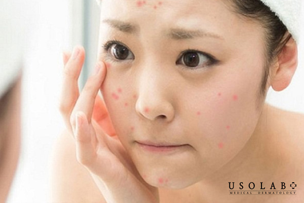 Sai lầm khi skincare cho da dầu mụn là bỏ qua bước dưỡng ẩm vì sợ bí da