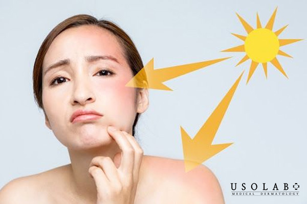 Dùng quá ít kem là sai lầm khi sử dụng kem chống nắng
