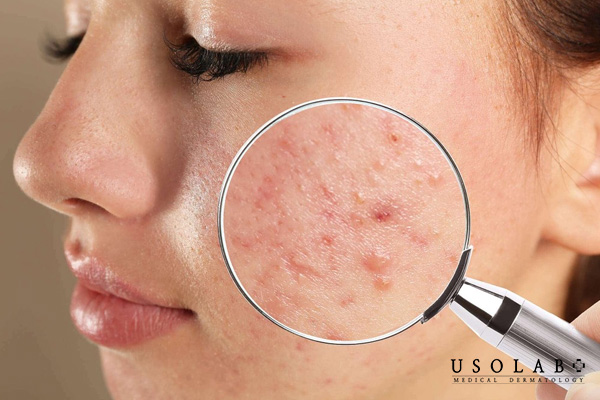 Skincare kỹ vẫn bị nổi mụn do sử dụng sản phẩm không phù hợp với da