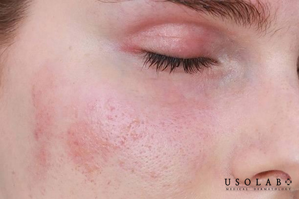 Treatment nhưng không cấp ẩm cho da