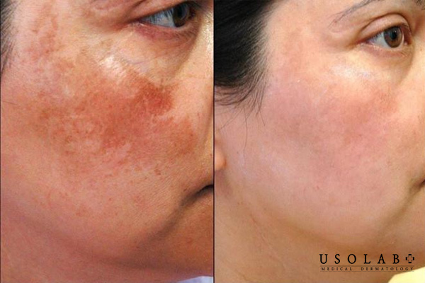 Treatment da trị được nám và thâm