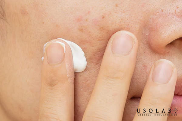 Người bị mụn trứng cá đang dùng Benzoyl peroxide điều trị