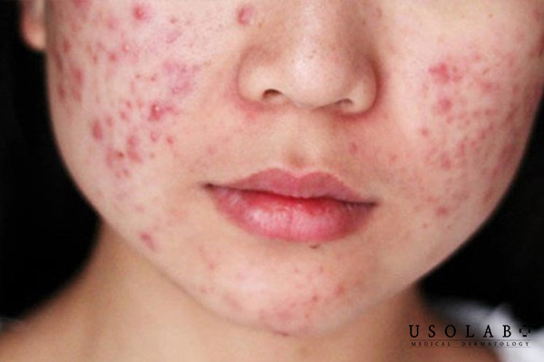 Da đang bị mụn KHÔNG nên sử dụng kem chống lão hóa