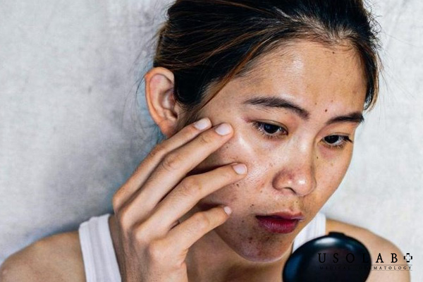 5 Bước chăm sóc da mặt bị cháy nắng