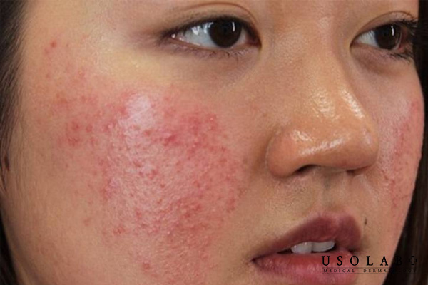 Da đang treatment mà đột nhiên nổi mụn nhiều có sao không
