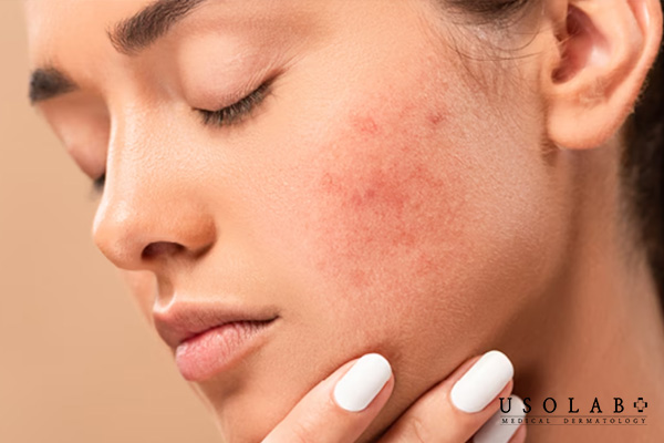 Nhiệt độ cao khiến da dễ tổn thương