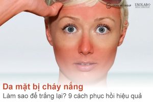 Da mặt bị cháy nắng làm sao để trắng lại