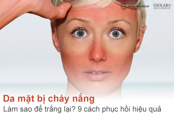 Da mặt bị cháy nắng làm sao để trắng lại