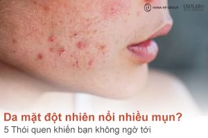 Vì sao da mặt đột nhiên nổi nhiều mụn? 5 Thói quen khiến bạn không ngờ tới