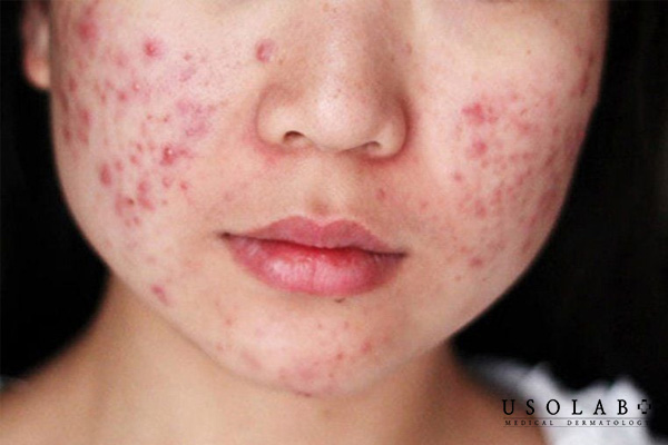 Cơ thể đang bị rối loạn nội tiết tố dẫn đến mụn bùng phát trên da mặt