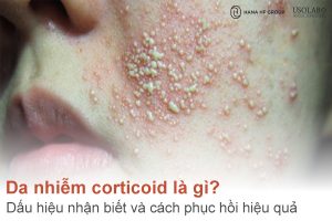Da nhiễm corticoid là gì? Dấu hiệu nhận biết và cách phục hồi hiệu quả