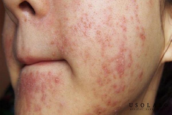 Do sử dụng mỹ phẩm có chứa corticoid trong thời gian dài.