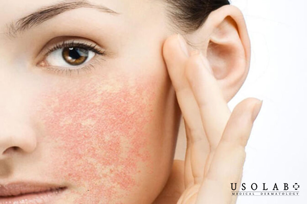 Da nhiễm corticoid có khả năng phục hồi nếu được điều trị đúng cách