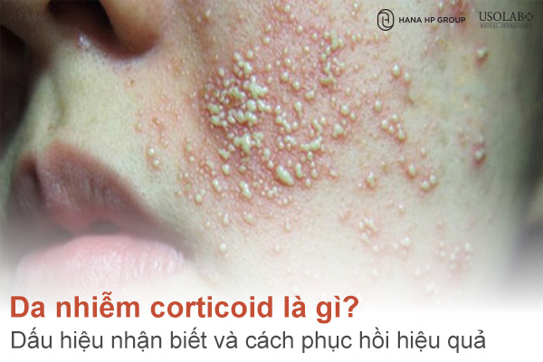 Da nhiễm corticoid là gì? Dấu hiệu nhận biết và cách phục hồi hiệu quả