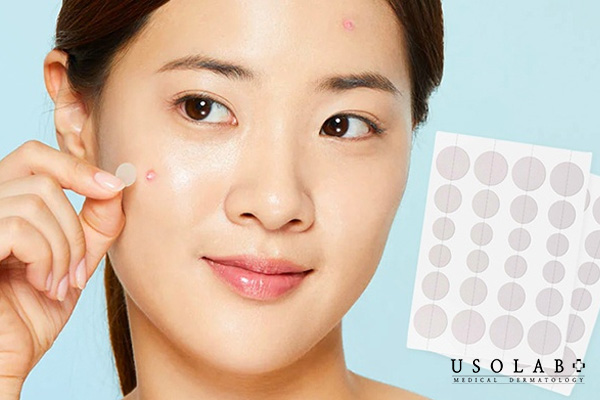 Dán mụn khi chưa có đầu – khiến viêm nặng hơn
