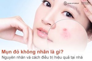 Mụn đỏ không nhân là gì? Nguyên nhân và cách điều trị hiệu quả tại nhà