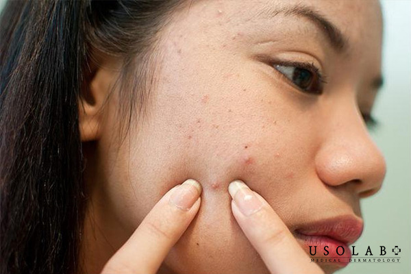 Nặn mụn sai cách khiến lỗ chân lông to