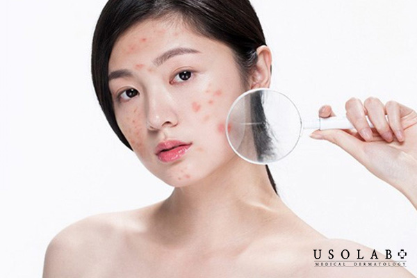 Rối loạn nội tiết, chăm sóc da chưa đúng