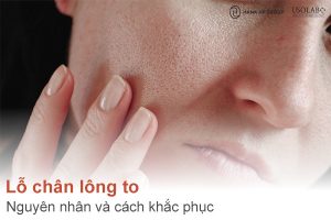 Nguyên nhân khiến lỗ chân lông to và cách khắc phục
